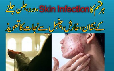 Har Qism Ke Skin Infection Se Nijat Ka Taweez