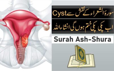Ovarian Cyst Treatment In Urdu