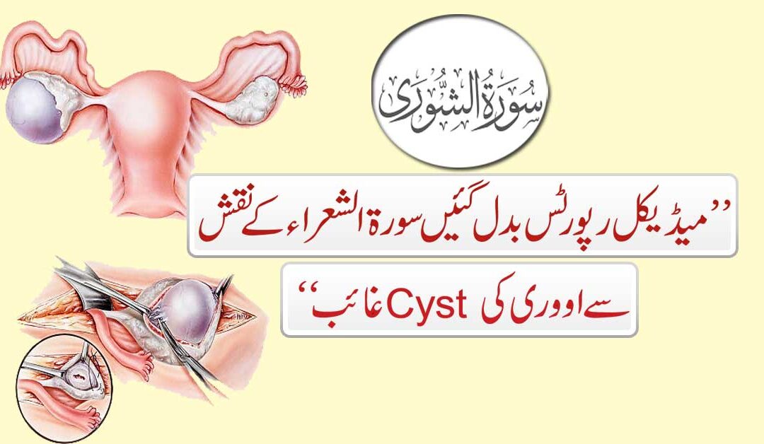 Cyst Pani Ki Theliyan Khatam Karne Ka Taweez